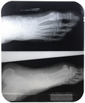 Elvis Presley's X-Ray of His Right Foot from the Day After the February 18, 1973 On-Stage Attack at the Las Vegas Hilton!